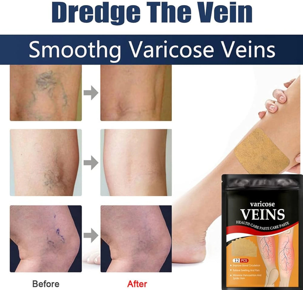 Navveda Turmeric Varicose Vein Patches | Natural Herbal Therapy for Swelling, Fatigue & Vein Health