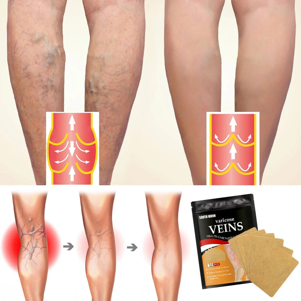 Navveda Turmeric Varicose Vein Patches | Natural Herbal Therapy for Swelling, Fatigue & Vein Health