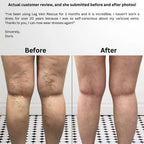 Navveda Turmeric Varicose Vein Patches | Natural Herbal Therapy for Swelling, Fatigue & Vein Health