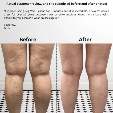 Navveda Turmeric Varicose Vein Patches | Natural Herbal Therapy for Swelling, Fatigue & Vein Health